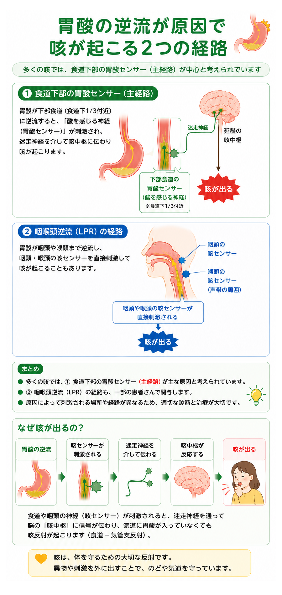 胃酸の逆流が原因で咳が起こる2つの経路：食道下部の胃酸センサー（主経路）と、咽喉頭逆流（LPR）の経路の図解
